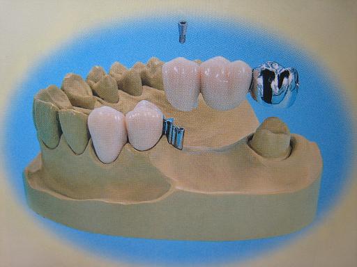 栓道式精密附着体