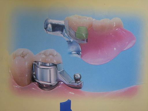 球形精密附着体（快套式）