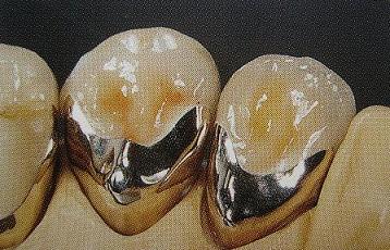 钴铬合金烤瓷牙