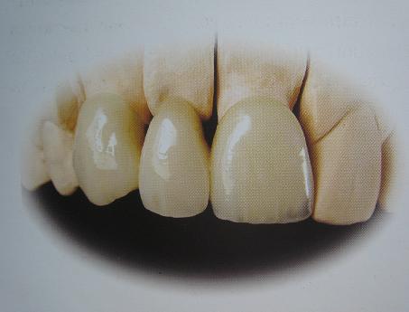 普通镍铬合金烤瓷