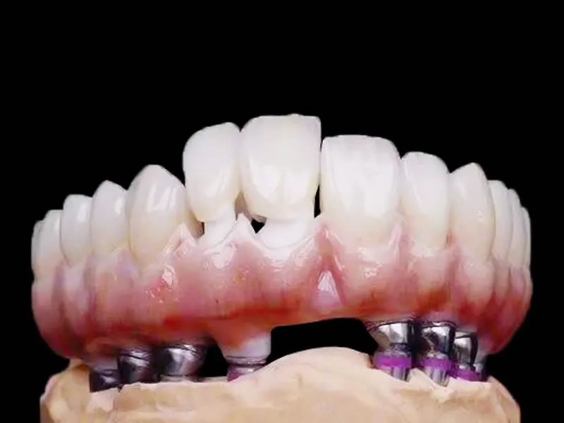 二氧化锆烤瓷牙