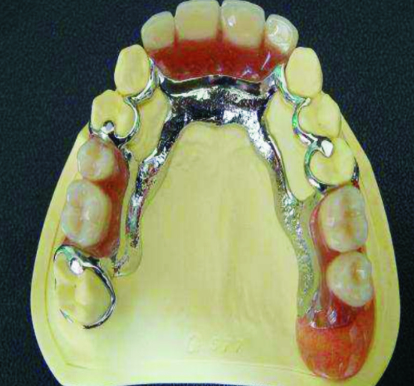 纯钛数字化切削支架